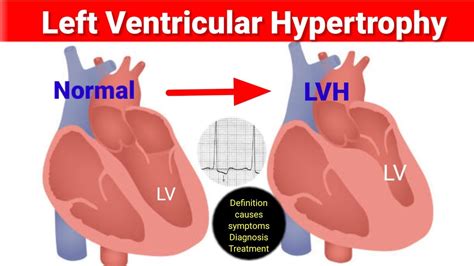 is hyperdynamic left ventricle serious|left ventricular hypertrophy test results.